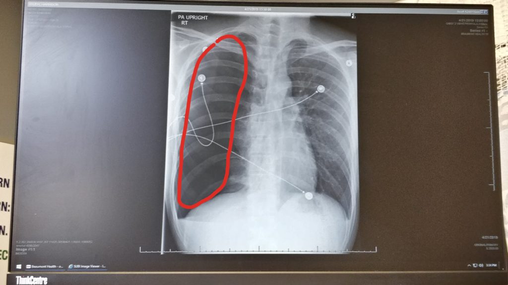 pneumothorax chest x-ray